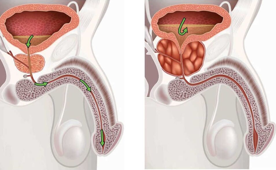 Prostate inflammation