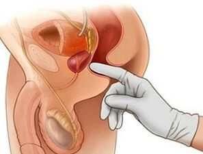 Prostate massage to treat prostatitis in men