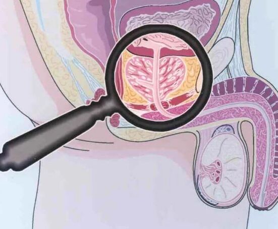 prostatitis